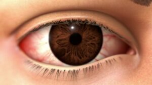 New treatment for severe corneal inflammation from DED now listed on PBS PlatoBlockchain Data Intelligence. Vertical Search. Ai.