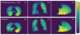 Images de ventilation CT produites par réseau neuronal