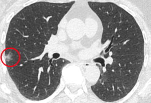 Akciğer kanserini daha erken tespit etmek için tek hücreleri aydınlatıyor PlatoBlockchain Veri Zekası. Dikey Arama. Ai.