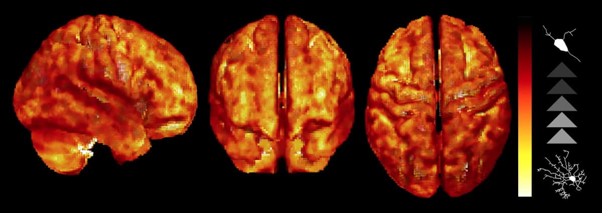 研究人员使用 MRI PlatoBlockchain 数据智能生成首张脑炎症体内图像。垂直搜索。人工智能。
