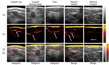 Optoacoustic imaging identifies breast cancer from vascular patterns PlatoAiStream Data Intelligence. Vertical Search. Ai.