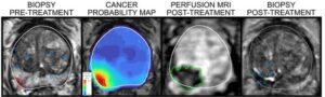 AI laser probe for prostate cancer enters clinical trials PlatoAiStream Data Intelligence. Vertical Search. Ai.