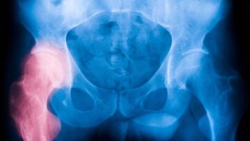 No se encontraron diferencias entre la anestesia espinal y la general para personas sometidas a una cirugía de fractura de cadera PlatoBlockchain Data Intelligence. Búsqueda vertical. Ai.