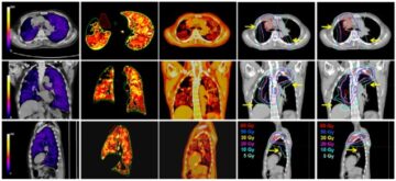 CT wentylacji wzmocnionej ksenonem chroni płuca podczas radioterapii PlatoBlockchain Data Intelligence. Wyszukiwanie pionowe. AI.
