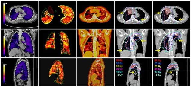 Xenon ile geliştirilmiş ventilasyon CT'si radyoterapi sırasında akciğerleri korur PlatoBlockchain Data Intelligence. Dikey Arama. Ai.
