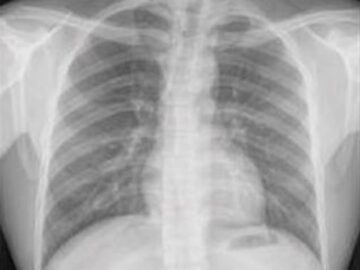 AI-modellen bestemmer kardiovaskulær risiko fra rutinemessig thorax-røntgen PlatoBlockchain Data Intelligence. Vertikalt søk. Ai.