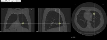 使用 Amazon SageMaker JumpStart PlatoBlockchain Data Intelligence 上的多模式数据预测肺癌生存状态。垂直搜索。人工智能。