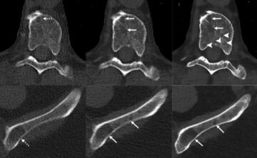 A fotonszámláló CT javítja a mielómás csontbetegség kimutatását a PlatoBlockchain Data Intelligence. Függőleges keresés. Ai.