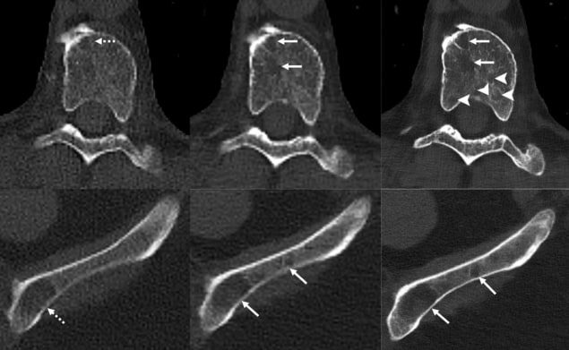 Photonenzählende CT verbessert die Erkennung der Myelom-Knochenerkrankung PlatoBlockchain Data Intelligence. Vertikale Suche. Ai.