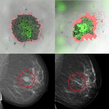 Μια νέα τεχνική βοηθά τα άτομα με καρκίνο του μαστού να επιλέξουν την καλύτερη θεραπεία PlatoBlockchain Data Intelligence. Κάθετη αναζήτηση. Ολα συμπεριλαμβάνονται.