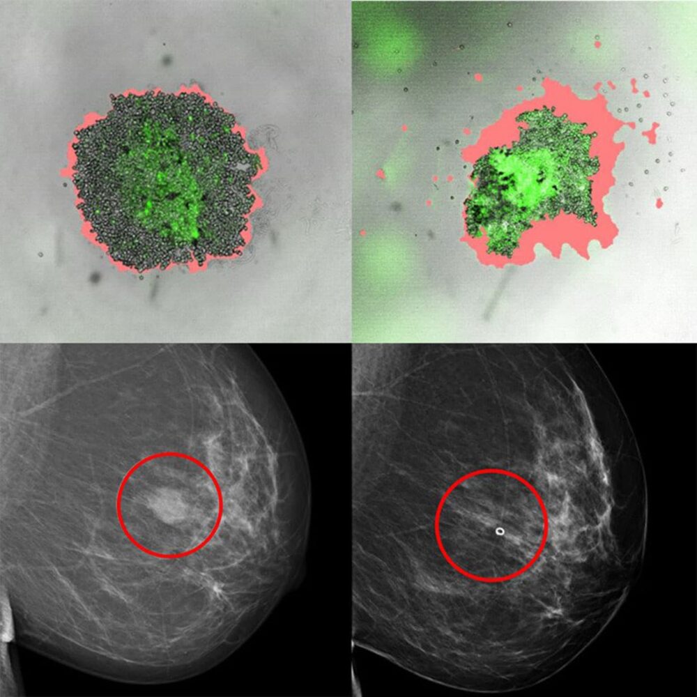 एक नई तकनीक स्तन कैंसर से पीड़ित लोगों को सर्वोत्तम उपचार चुनने में मदद करती है प्लेटोब्लॉकचेन डेटा इंटेलिजेंस। लंबवत खोज. ऐ.