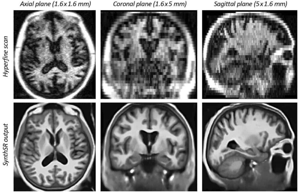 AI کم فیلڈ طاقت والے MR اسکینوں سے ہائی ریزولوشن دماغ کی تصاویر بناتا ہے۔
