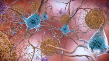 GPT-3'ün Sonraki İşareti: Alzheimer'ı Konuşma Yoluyla Teşhis Etmek