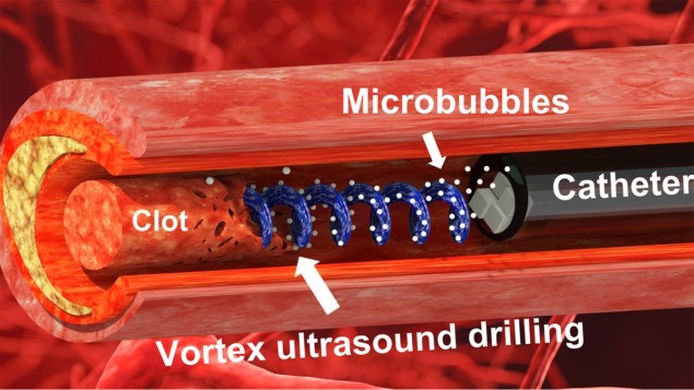 La herramienta de ultrasonido Vortex descompone los coágulos de sangre en el cerebro
