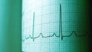 Конкурирующие кардиостимуляторы создают характерные тройки сердечных сокращений