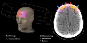 Spremljanje oksigenacije možganskega tkiva v realnem času bi lahko prilagodilo radioterapijo