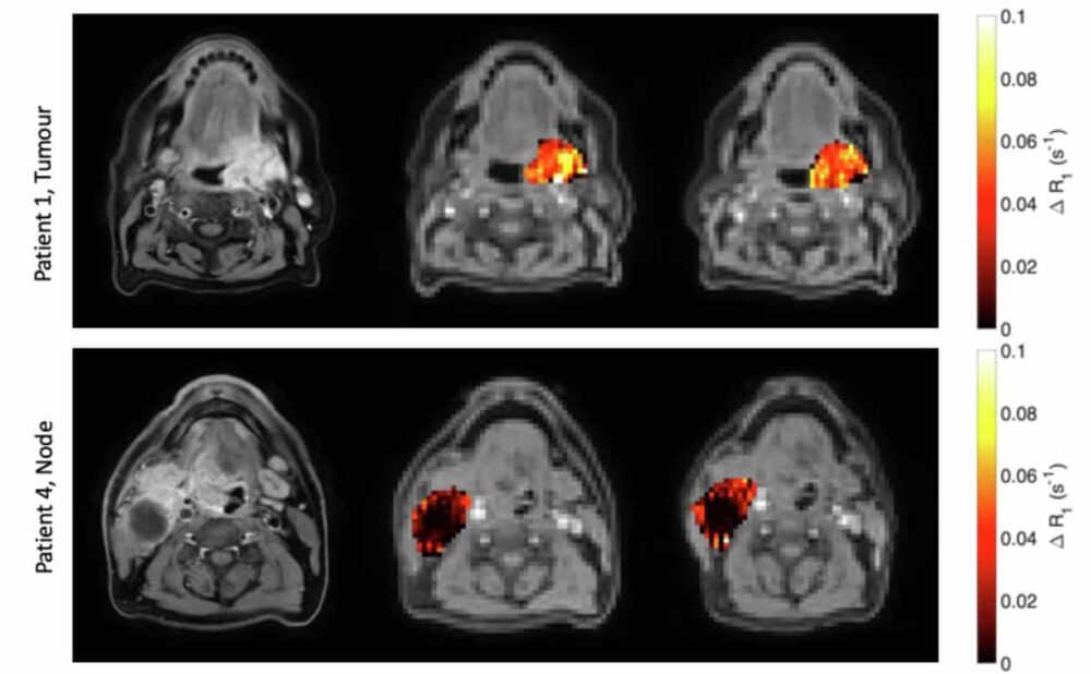 Rumo à combinação de imagens de hipóxia e radioterapia adaptativa