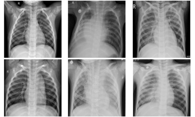 Machine-learning framework classifies pneumonia on chest X-rays
