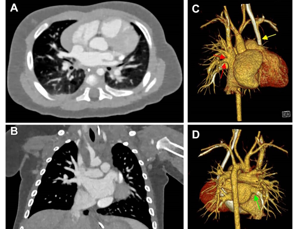 Η CT με μέτρηση φωτονίων βελτιώνει την καρδιακή απεικόνιση σε βρέφη με καρδιακά ελαττώματα – Physics World