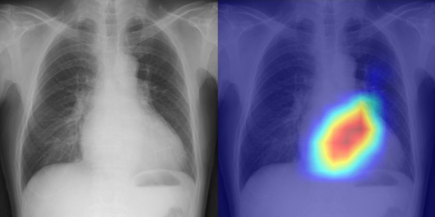 Modelo de aprendizaje profundo utiliza rayos X de tórax para detectar enfermedades del corazón – Physics World