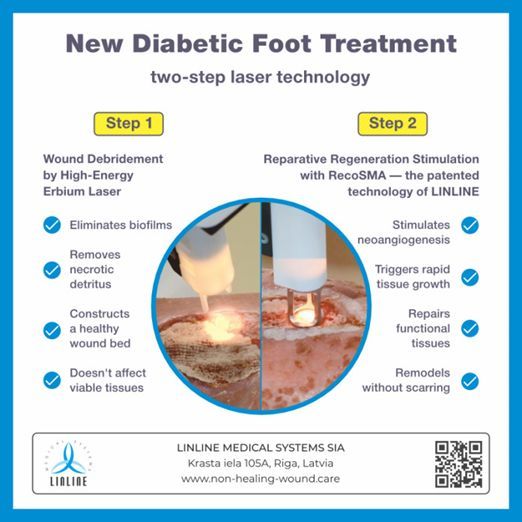 Un studiu revoluționar dezvăluie eficacitatea noului tratament cu laser RecoSMA pentru piciorul diabetic