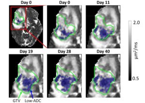 Hình ảnh trên MR-Linac xác định khối u não kháng bức xạ – Vật lý Thế giới