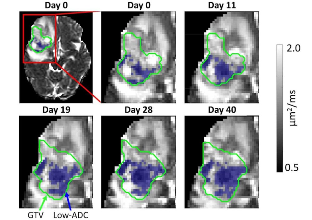 Imagens em um MR-Linac identificam tumores cerebrais resistentes à radiação – Physics World