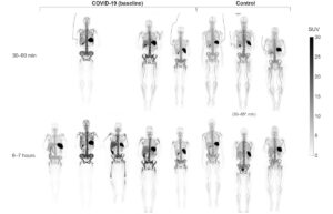 PET-beeldvorming van het hele lichaam onthult de immuunrespons bij COVID-19-patiënten – Physics World