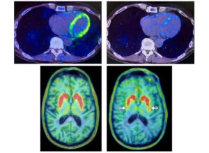Hjerte-PET-scanninger kan forudsige indtræden af ​​neurodegenerativ sygdom hos personer i risikozonen - Physics World
