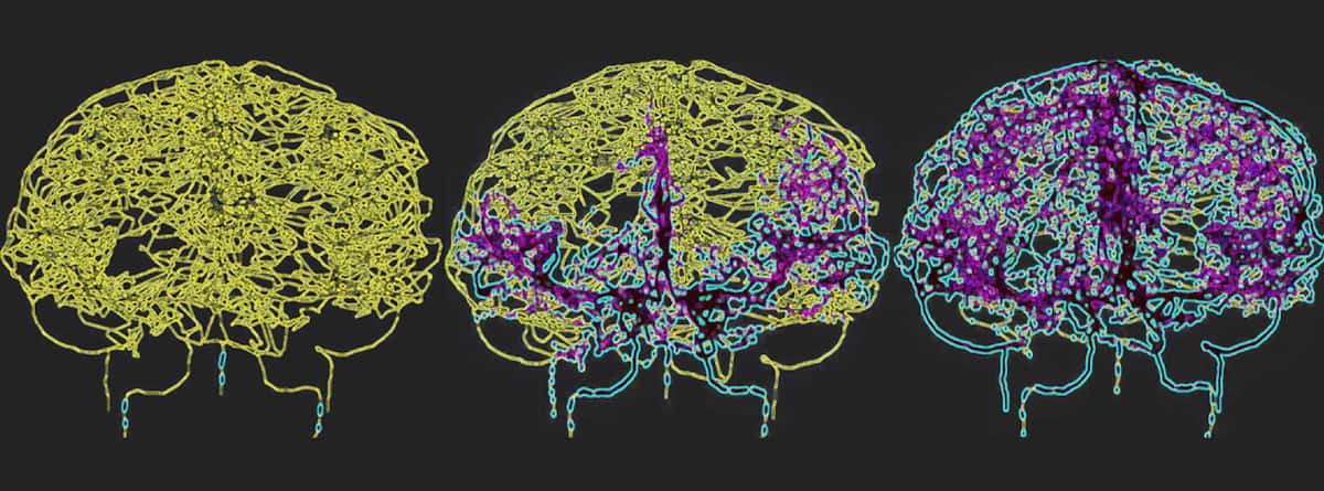 نمذجة تدفق الدم في الدماغ