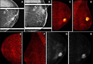 Una técnica de imagen molecular podría mejorar el cribado del cáncer de mama – Physics World