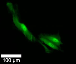 Images de fluorescence de cellules cancéreuses du cerveau