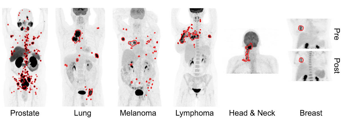 Deep transfer learning-predicted tumour segmentations 